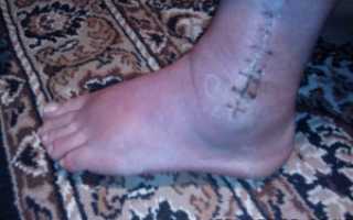 Волдыри возле раны после операции на голеностопе