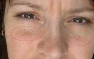 Чёрное пятно под глазом и на щеке