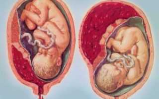 Краевое предлежание плаценты