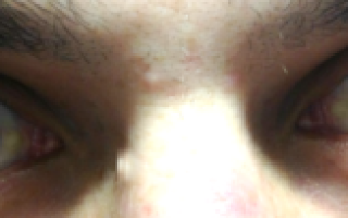 На левом глазу появилось белое пятно. Что это?