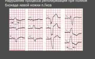 Диффузное нарушение процесса реполяризации и синусовый ритм