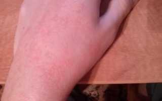 Кожа чешется, краснеет и взбухает и в течении часа проходит