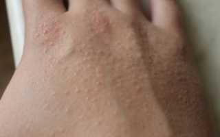 Мелкие прыщики на руках переходящие в черные точки