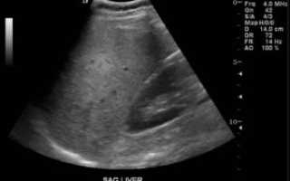 УЗИ печени, жировой гепатоз