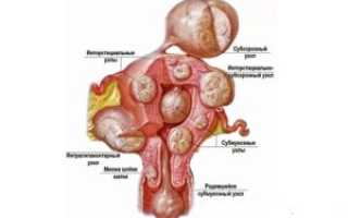 Миома и цистит -есть ли связь?