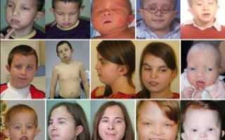 Можно ли вылечить синдром делеции 1q21.1 (OMIM: 612474)