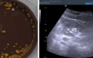 Микролиты в почках