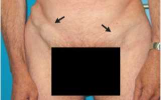 Воспаление лимфоузла в паховой области