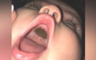 Черное пятно на нёбе