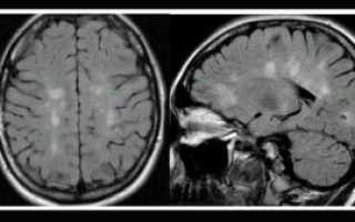 Врач на МРТ сказал, что это рассеянный склероз
