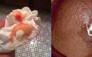 Менструальноподобные выделения