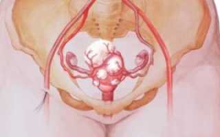 Миома и цистит -есть ли связь?