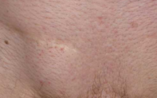 Красная и твердая шишка на лобке