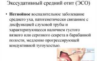 Экссудативный отит