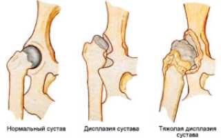 Дисплазия тазобедренных суставов