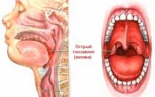 Воспаление глотки