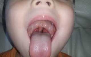 Высокая температура и красное горло строго раз в месяц