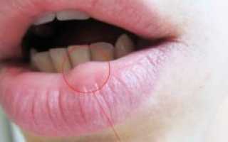 Воспаление на нижней губе