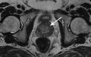 МРТ предстательной железы