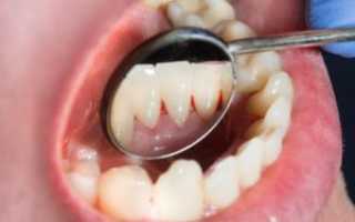 Воспаление десны после использования зубочистки