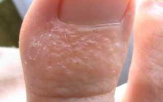 Экзема на большом пальце ноги