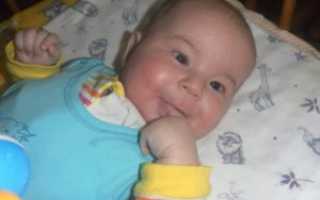 Косоглазие в 4,5 месяца