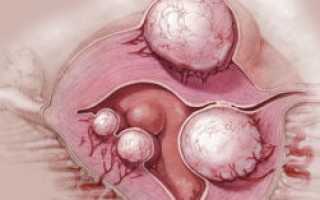 Миома матки интрамуральная, фоликулярная киста левого яичника