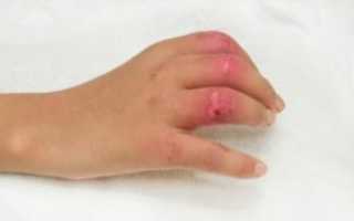 Высох палец после раны