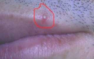 Временами зуд, белый налёт и прыщики на головке полового члена