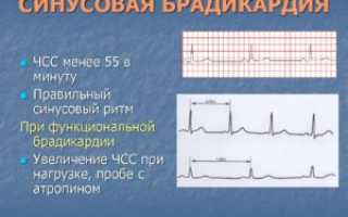 Можно делать общий наркоз при брадикардии, ритм синусовый