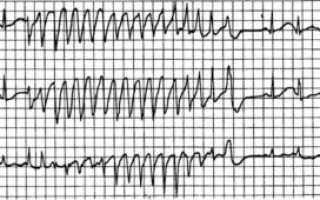Экг с ненормальным ритмом