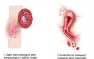 Чи можна завагітніти після першого аборту?