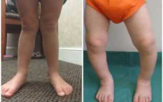 Варус или вальгус?