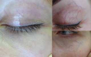 Вены под глазами