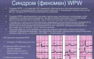 Двухклапанное сердце, clc и wpw феномен у ребенка