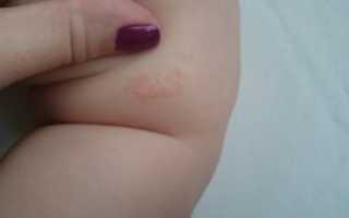 На попе у ребёнка сухие пятнышки