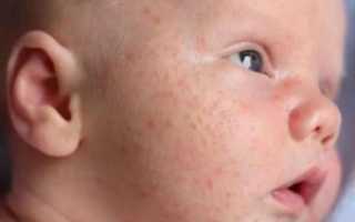 Мелкие прыщики на лице у грудничка