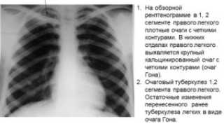 Единичный очаг в легких у ребенка