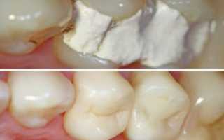 Временная пломба на молочном зубе откололась