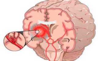 Думали инсульт, оказалось — опухоль головного мозга. Что делать?