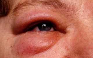 Крапивница и отёк слизистой носа