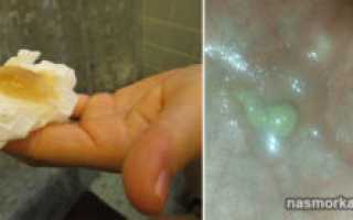 Что значит выходящая мокрота ввиде комочков из горла