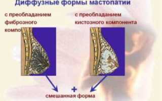 Дифузная фибромо-кистозная мастопатия