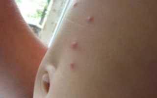 Волдырь на животе