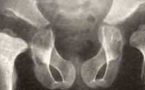 Эпифизарная дисплазия