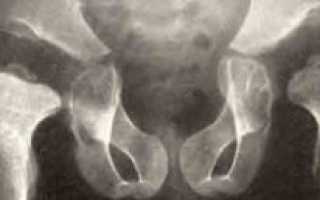 Эпифизарная дисплазия