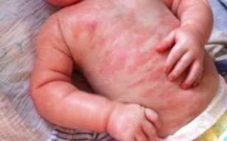 Крапивница 4 день