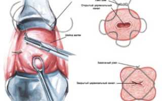 Выделения после наложения шва