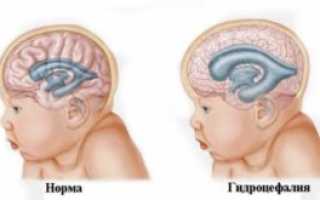 Вентрикуломегалия у грудничка