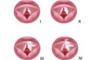 ВПЧ и ротоглотка